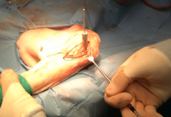 procedura chirurgica 016